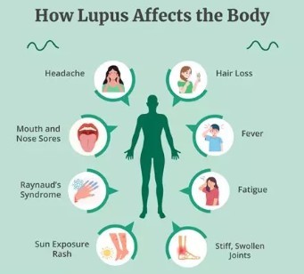 Image of how lupus can affect a body